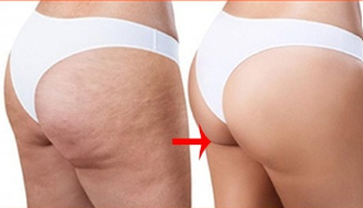 Anticelulítico— Hidratación Profunda