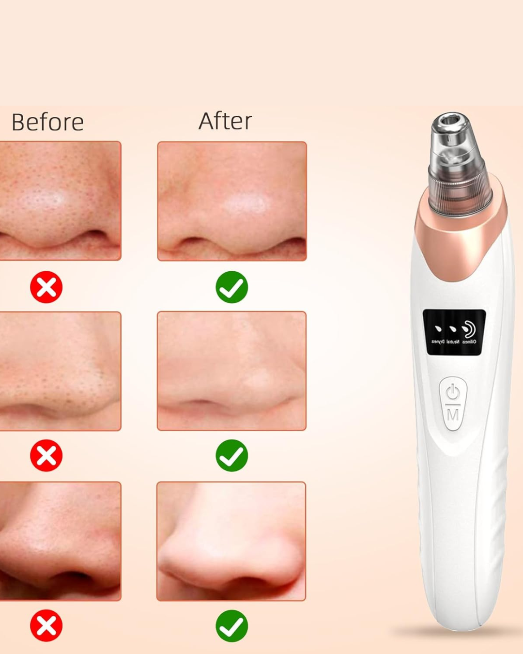 Removedor de puntos negros por succión — PoreClean Pro™