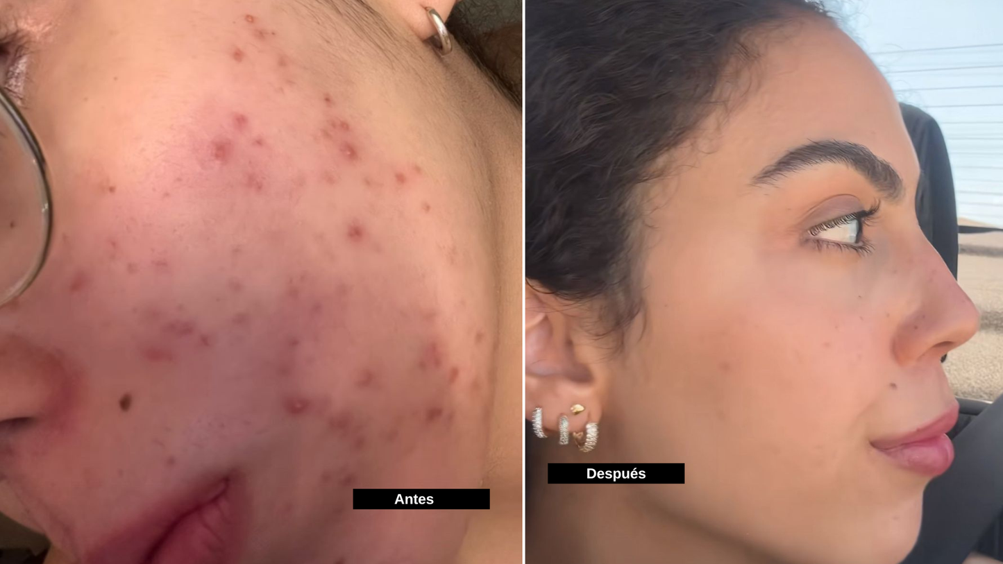 Sérum Reparador de Acné y Cicatrices – Regenera tu piel, renueva tu confianza